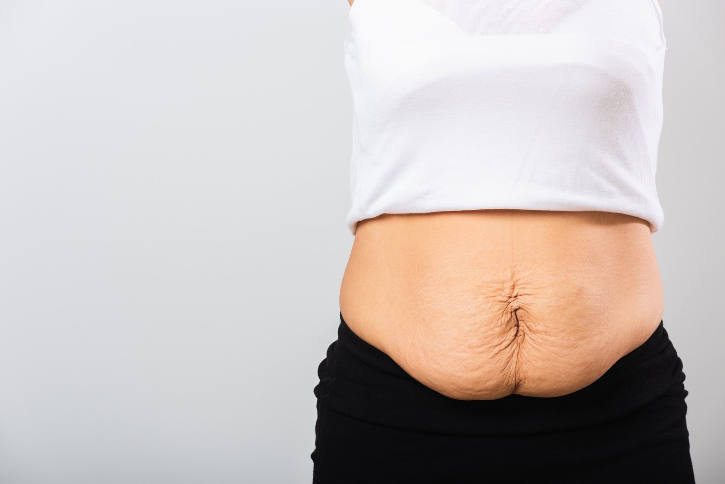 Woman with Loose Postpartum Stomach  